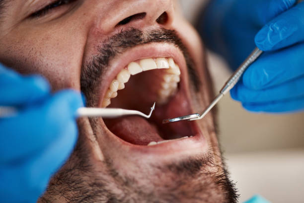 Best Chipped Tooth Repair Near Me  in Jonesboro, LA